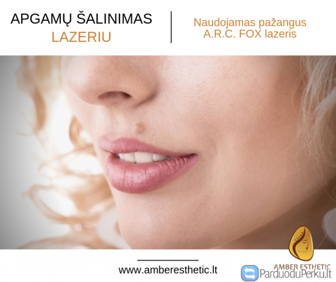 Apgamų šalinimas lazeriu Kaune