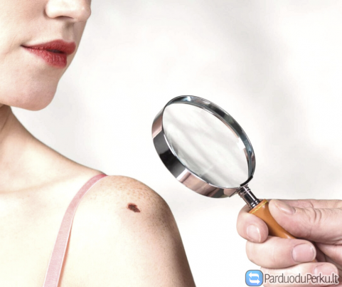 Apgamų šalinimas lazeriu