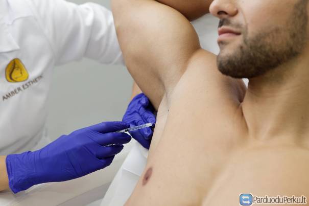 Botulino injekcijos nuo prakaitavimo