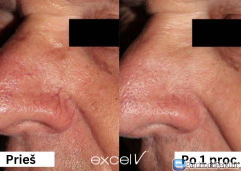 Kapiliarų Šalinimas Cutera Excel V+ Lazeriu Kaune